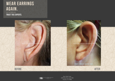 Before & After Earlobe Surgery 13