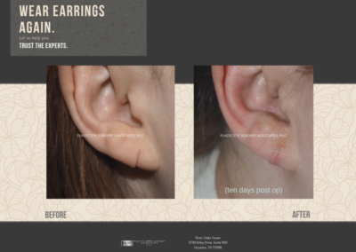 Before & After Earlobe Surgery 7