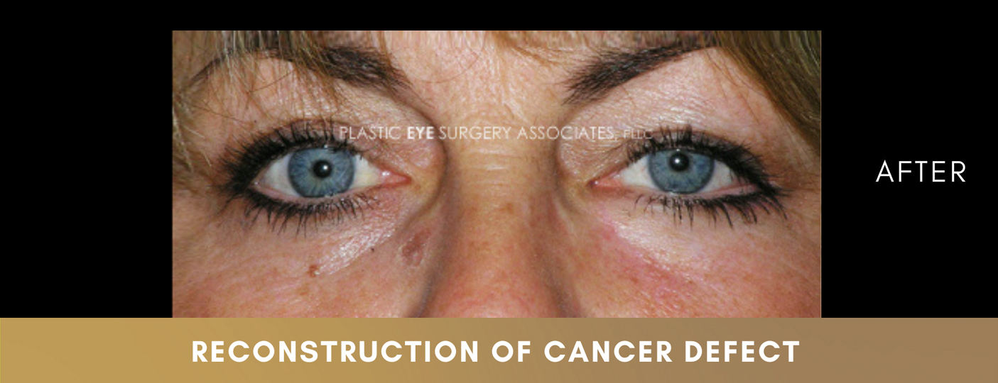 Eyelid Skin Cancer Reconstruction 2