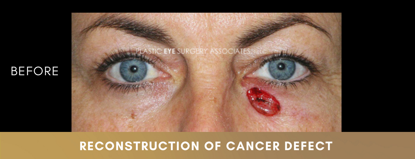 Eyelid Skin Cancer Reconstruction 1