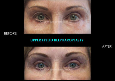 Eyelid Reshaping Photos 93
