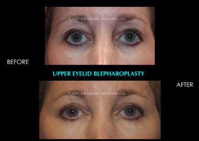 Eyelid Reshaping Photos 97