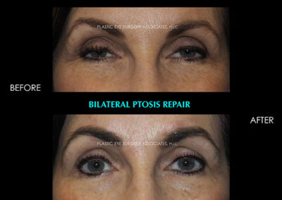 Eyelid Reshaping Photos 99