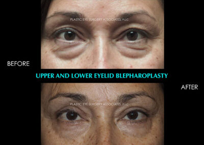 Eyelid Reshaping Photos 100