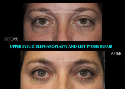 Female Blepharoplasty Photos 79