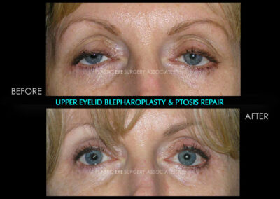 Eyelid Reshaping Photos 107