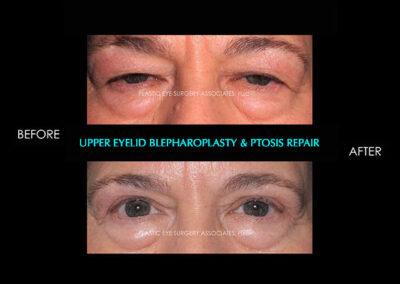 Eyelid Reshaping Photos 108