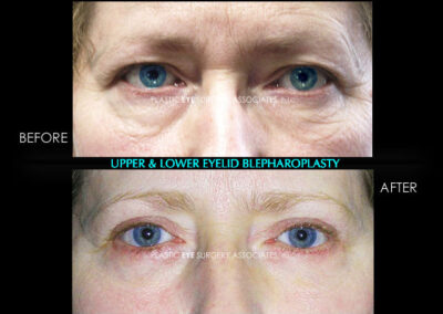 Eyelid Reshaping Photos 110