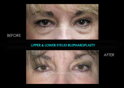 Female Blepharoplasty Photos 70