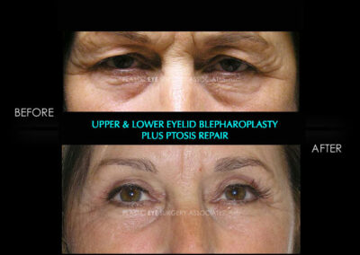 Eyelid Reshaping Photos 112