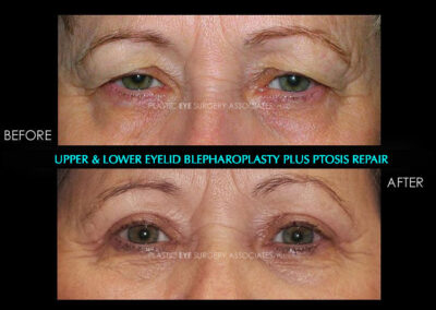 Eyelid Reshaping Photos 1