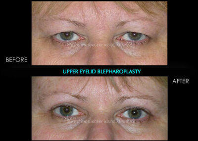 Eyelid Reshaping Photos 3