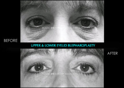 Eyelid Reshaping Photos 4
