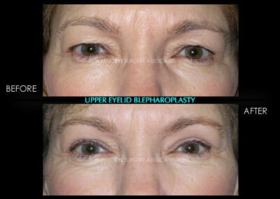 Eyelid Reshaping Photos 5