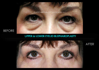 Female Blepharoplasty Photos 61