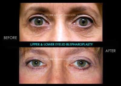 Female Blepharoplasty Photos 60