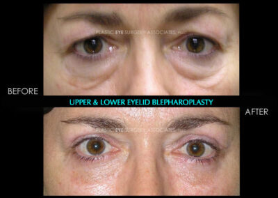Eyelid Reshaping Photos 13