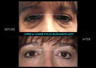 Female Blepharoplasty Photos 52