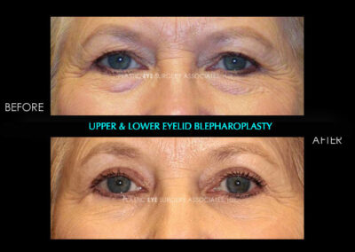Female Blepharoplasty Photos 49