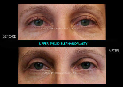 Eyelid Reshaping Photos 25