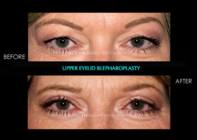 Eyelid Reshaping Photos 28