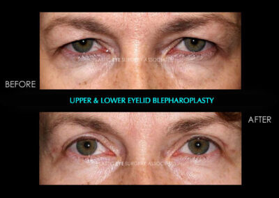 Eyelid Reshaping Photos 32
