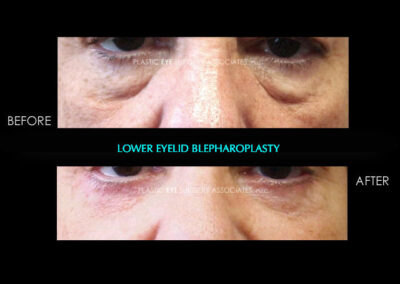 Eyelid Reshaping Photos 35