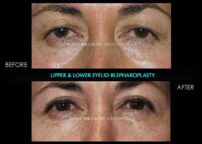 Female Blepharoplasty Photos 146