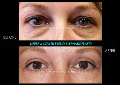 Eyelid Reshaping Photos 37