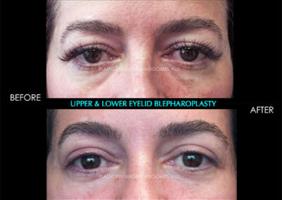 Eyelid Reshaping Photos 38