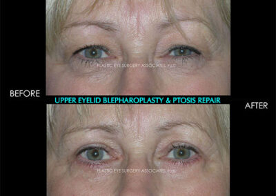 Eyelid Reshaping Photos 39