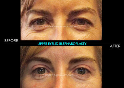 Female Blepharoplasty Photos 138