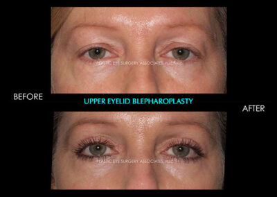 Eyelid Reshaping Photos 43