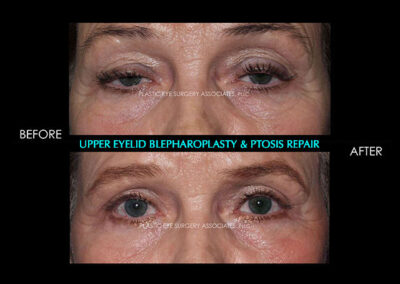 Eyelid Reshaping Photos 45