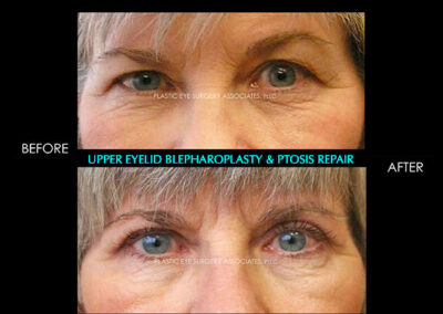 Eyelid Reshaping Photos 46