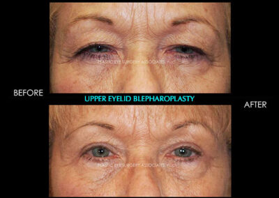 Eyelid Reshaping Photos 48