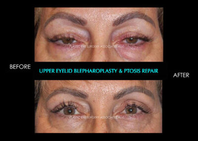 Eyelid Reshaping Photos 49