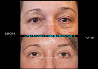 Eyelid Reshaping Photos 51
