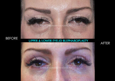 Eyelid Reshaping Photos 52