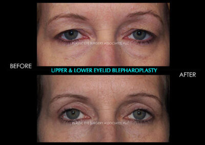 Eyelid Reshaping Photos 55