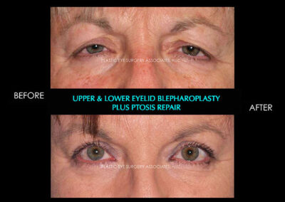 Eyelid Reshaping Photos 56