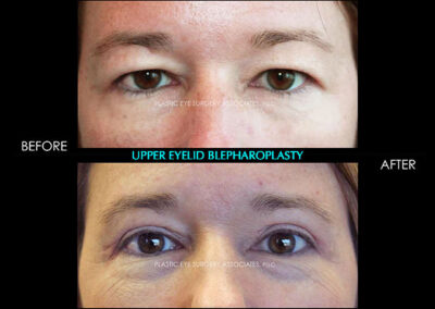 Eyelid Reshaping Photos 61