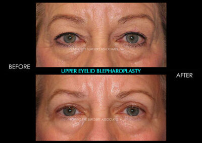 Eyelid Reshaping Photos 63