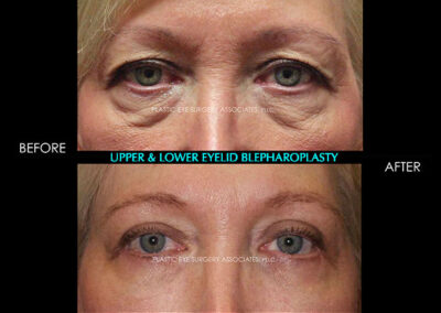 Female Blepharoplasty Photos 116