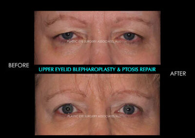 Female Blepharoplasty Photos 113