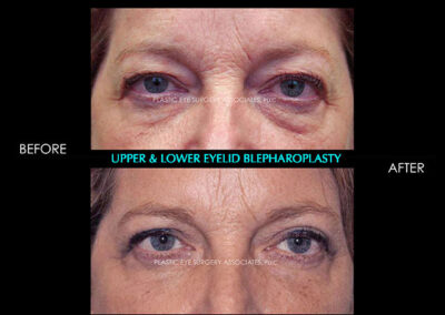 Eyelid Reshaping Photos 68