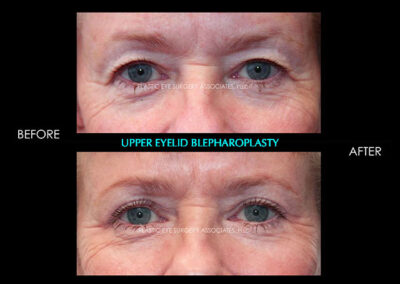 Eyelid Reshaping Photos 69