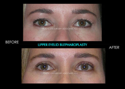 Eyelid Reshaping Photos 71
