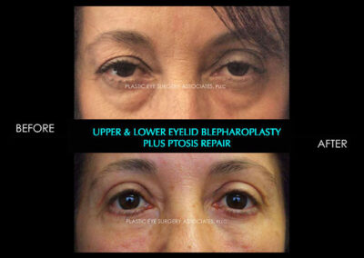 Eyelid Reshaping Photos 73