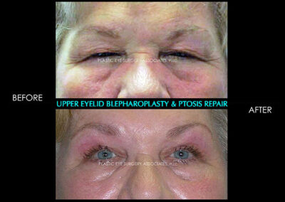 Eyelid Reshaping Photos 75